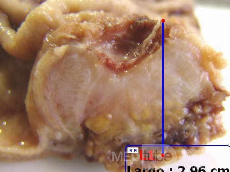 Adenocarcinoma of the Antrum and incisura angularis (6 of 12)