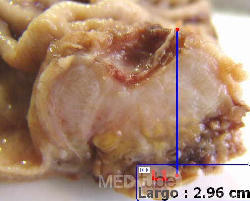 Adenocarcinoma of the Antrum and incisura angularis (6 of 12)
