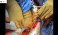Right NUT and Cystectomy in Extrophic Uncorrected Bladder