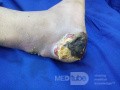 Diabetic Heel Ulcer with Achill's Infection