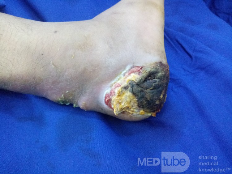 Diabetic Heel Ulcer with Achill's Infection