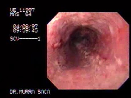 Severe Esophagitis - Erosions With Whitish Exudate