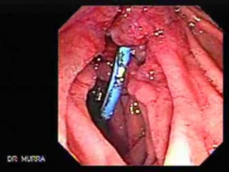 Adenocarcinoma of the Vater Papilla - Stent Migration (4 of 7)