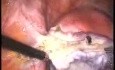 Laparoscopic Bilateral Genital Adnexectomy