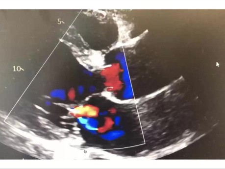 Echocardiographic Evaluation of Aortic Regurgitation