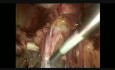 Minilaparoscopic (TEP-TAPP) Combined Approach for Inguinal Hernia