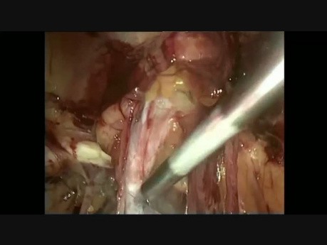 Minilaparoscopic (TEP-TAPP) Combined Approach for Inguinal Hernia