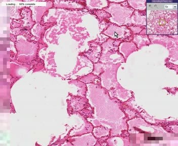 Lung - Acute Pulmonary Edema - Asbestos Bodies