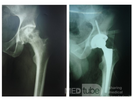 Total Hip Arthroplasty