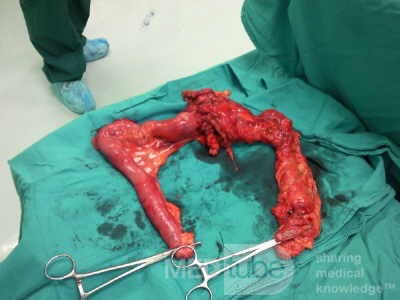 Non-Hodgkin's Lymphoma of the Colon (6 of 16)