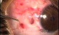 Angiomatous lesions under the conjunctiva removing by Fugo Plasma Blade