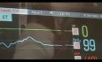Awake Mitral Valve Replacement -  Chordee Preservation EP Mode