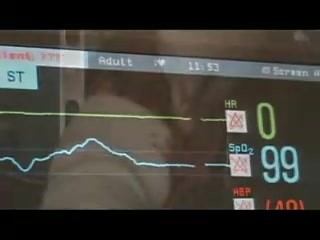 Awake Mitral Valve Replacement -  Chordee Preservation EP Mode