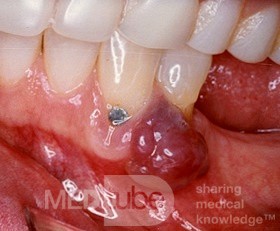 Epulides [giant cell granuloma]