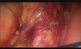 Laparoscopic Low Anterior Resection in Female Patient