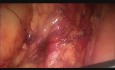 Laparoscopic Low Anterior Resection in Female Patient