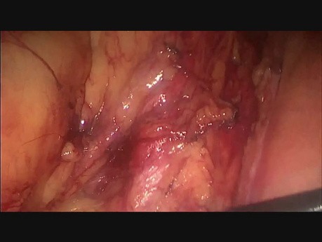 Laparoscopic Low Anterior Resection in Female Patient