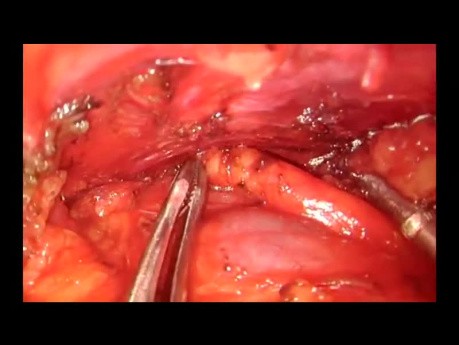 Subxiphoid Uniportal Thymectomy and Thymomectomy