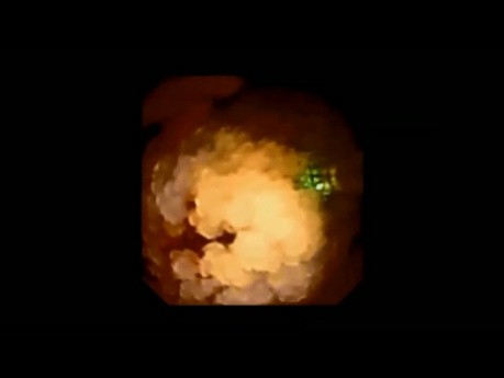 Lithotripsy Using Ball End Laser Fibre 
