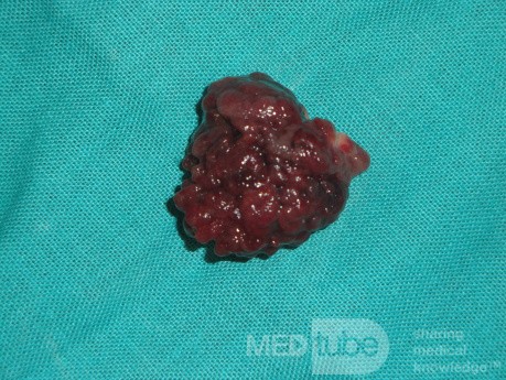 Giant Multilobulated Gastric Polyp (17 of 20)