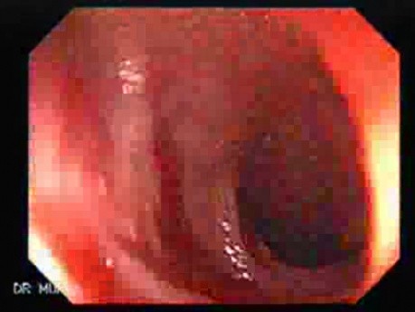 Colitis Ulcerosa - Pancolitis (7 of 7)