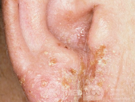 Neomycin Contact Dermatitis