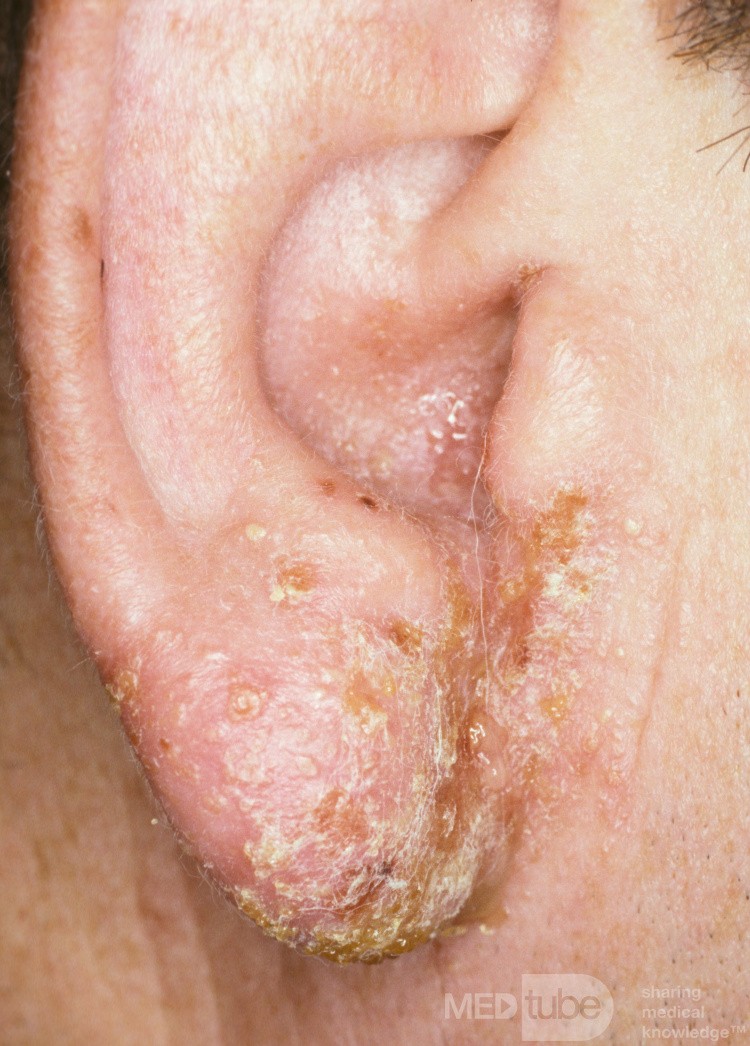 Neomycin Contact Dermatitis
