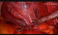 Laparoscopic Cholecystectomy in Adhesion Case