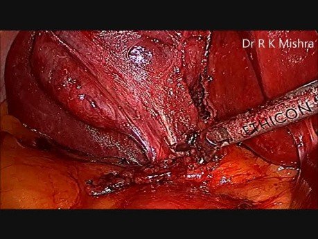 Laparoscopic Cholecystectomy in Adhesion Case