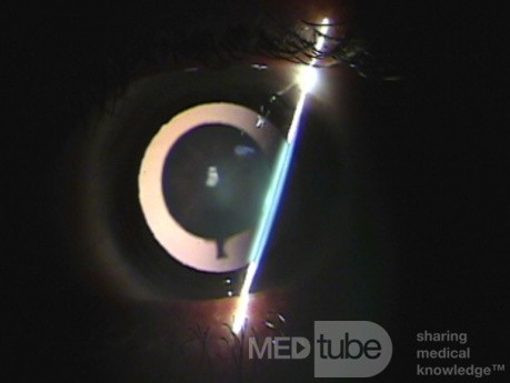Lamellar Cataract