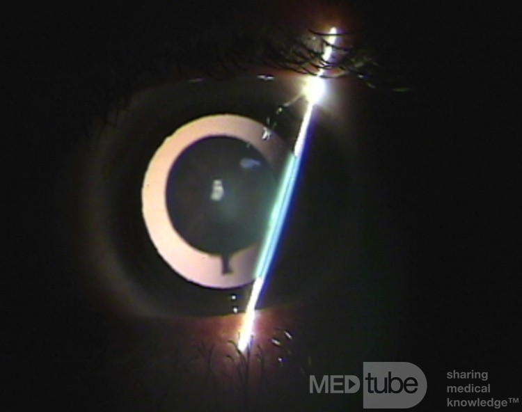lamellar cataract images