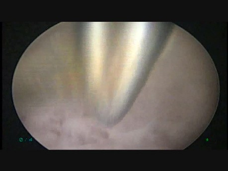 Hystroscopic Septum Resection with Scissors
