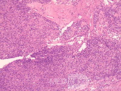 Gastrointestinal Stromal tumor (GIST) (55 of 65)