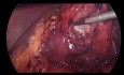 Difficult Lap Cholecystectomy