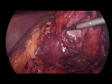 Difficult Lap Cholecystectomy