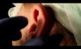 Retroauricular Approach - How to Perform