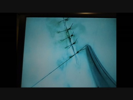 Microsurgery Tutorials. Lesson 3: Finesse. Mastering The Feel of Microsurgery. Petal Suture