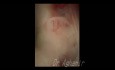 Flexible Ureterorenoscopy (RIRS) for Medullary Sponge Kidney Lithiasis