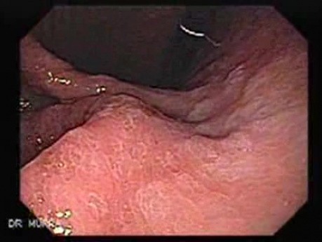 Gastric Cancer - Intestinal Metaplasia - Endoscopy (3 of 7)