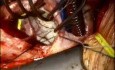 Mitral and Tricuspid Valve Repair