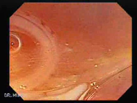 Schistosoma Mansoni in the Cecum (1 of 9)