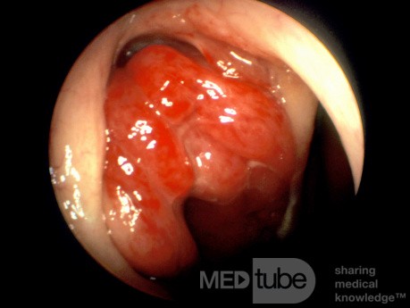 Nasopharyngeal Tumor