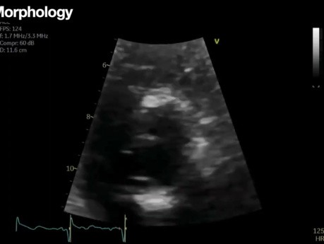 Echocardiographic Assessment of Aortic Stenosis