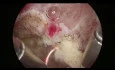 Hysteroscopic Resection of Fibroid