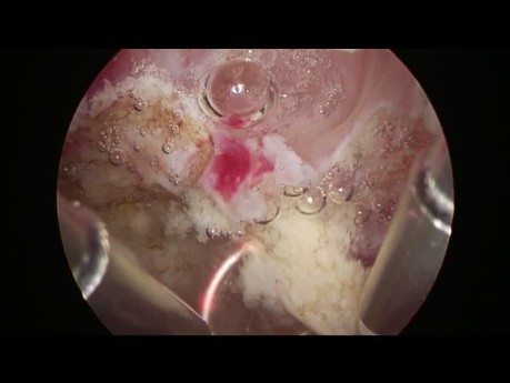 Hysteroscopic Resection of Fibroid
