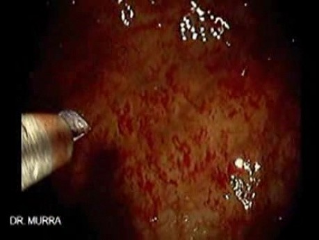 Gastric Varices (13 of 25)