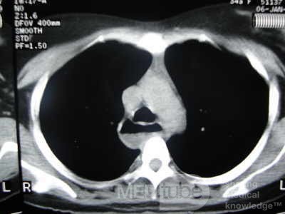 Esophagus - Pneumatic Dilation for Achalasia (29 of 31)