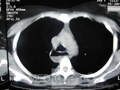 Esophagus - Pneumatic Dilation for Achalasia (29 of 31)