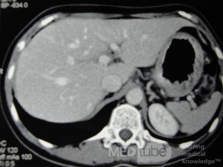 Endoscopy of Scirrhous Gastric Carcinoma involving the entire Fundus, Body and the Antrum (18 of 47)