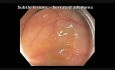 Colonoscopy Channel - Subtle Flat Lesion